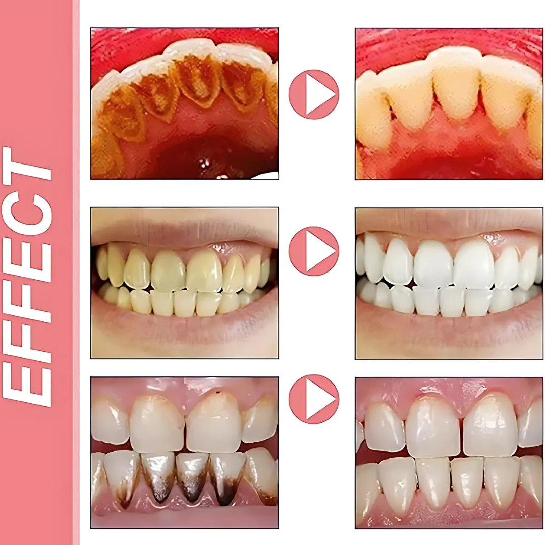ProbioticToothpaste 1+1 GRATIS: Teder Whitening Versterkende Probiotica Tandpasta